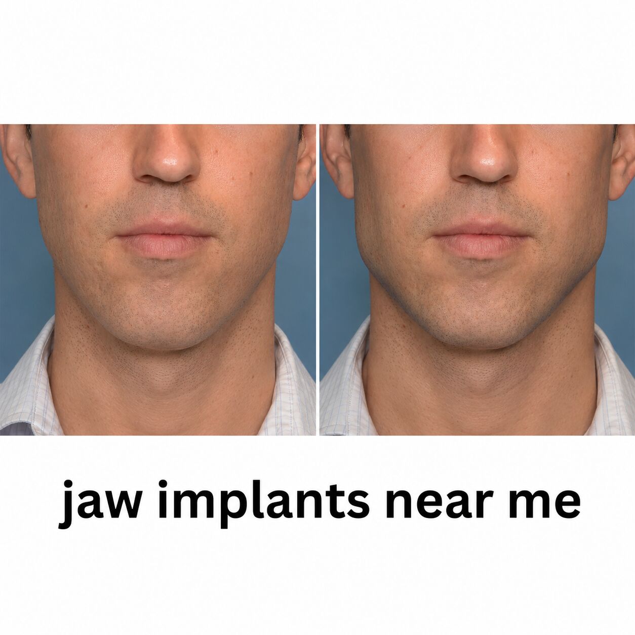Jaw Augmentation Surgery For A Stronger Jawline photo 1