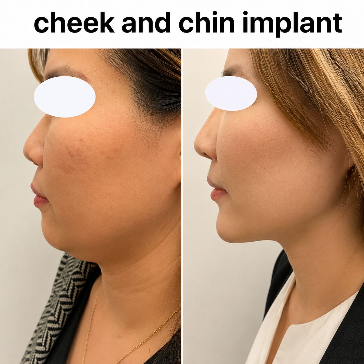 Surgical Chin Augmentation For Balanced Facial Features photo 1
